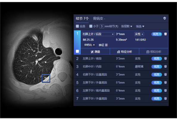 肺結節ct圖像輔助檢測軟件uai-pioneerchest聯影